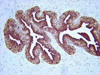 PSA (Catalog Number IHC2052-6) staining of human prostate carcinoma.  Tissue is pretreated, then detected with the IHC Select® Immunoperoxidase Detection System (Catalog Number DAB150).  Cancer cells stain strongly (brown) with no diffusive background.